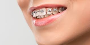 Affordable Braces: Expert Tips For Cost-Effective Treatment