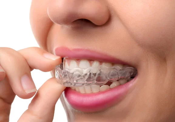 How To Determine Invisalign Cost